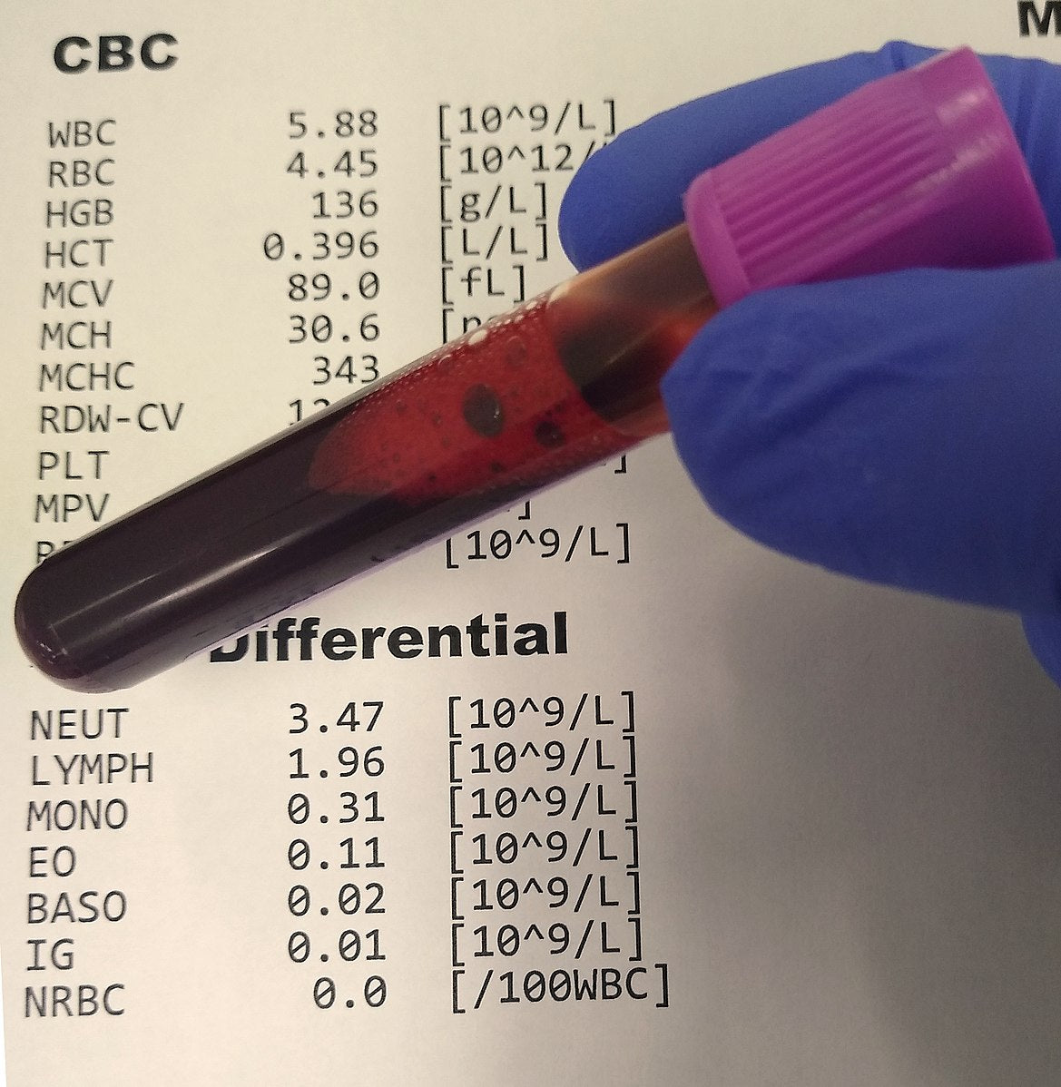 Hemoglobin and Hematocrit